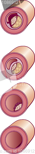 Image of Bad cholesterol in vein