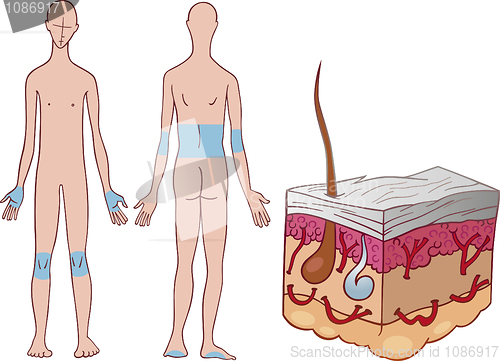 Image of Psoriasis