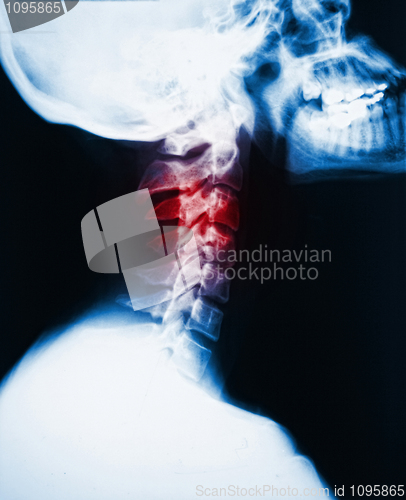Image of neck x-ray and pain