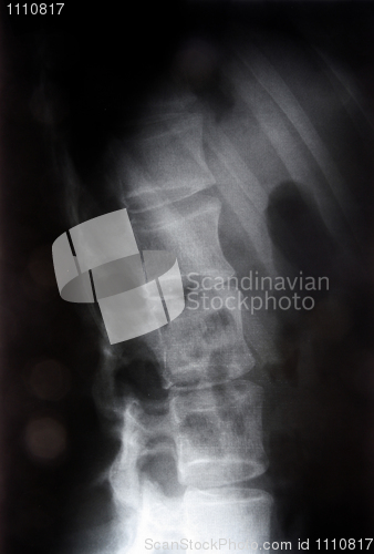 Image of X-ray