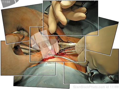 Image of Surgeons' Hands Collage- A real operation showing a thyroidectomy.