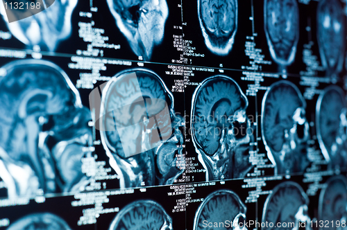 Image of Closeup of a CT scan with brain and skull on it