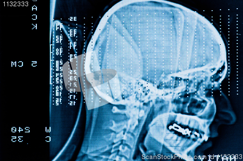 Image of Closeup of a CT scan with brain and skull on it