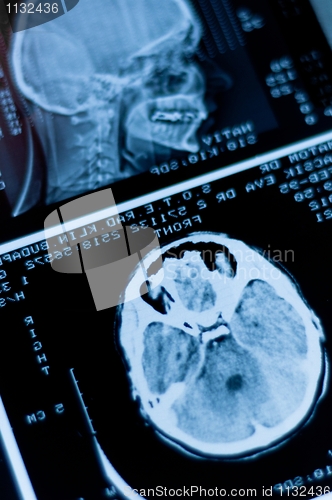 Image of Closeup of a CT scan with brain and skull on it