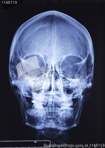 Image of skull xray