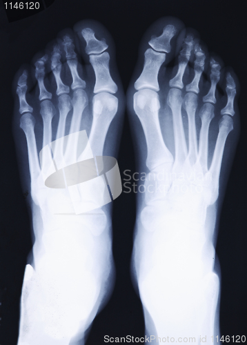 Image of feet xray