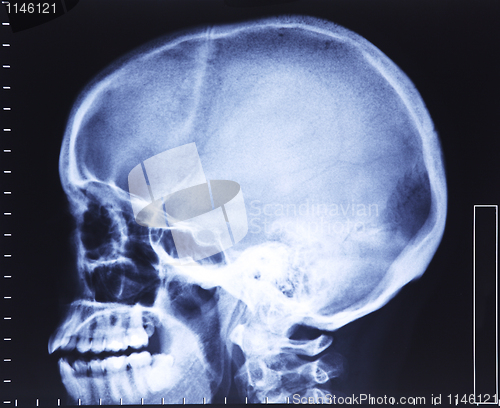 Image of skull xray