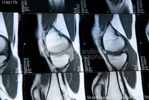 Image of mri knee