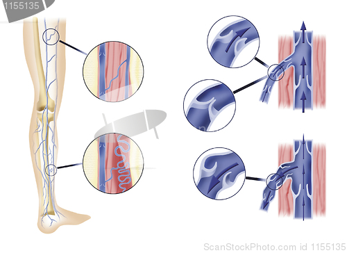 Image of leg artery and aortic valves