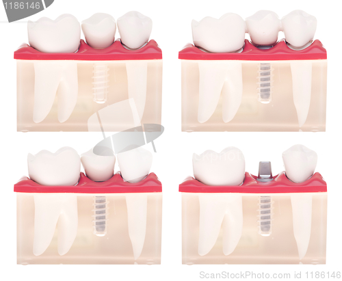 Image of Implant dental model