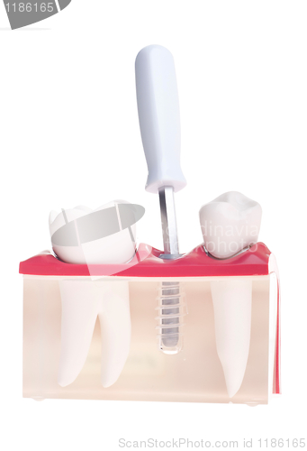 Image of Implant dental model