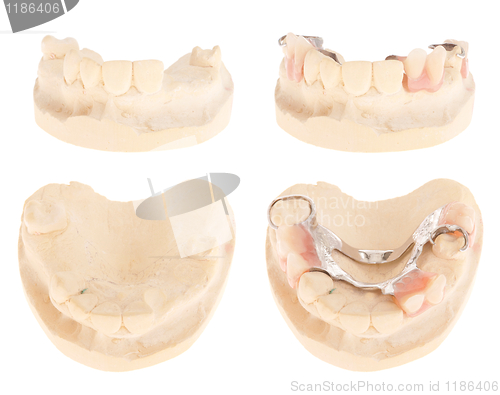 Image of Chrome cobalt denture