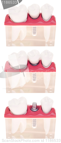 Image of Implant dental model