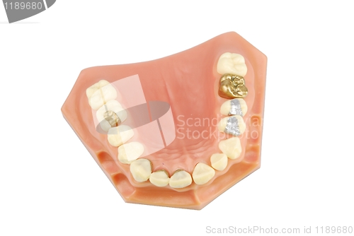 Image of Dental model (with different treatments)