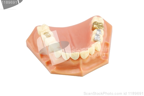 Image of Dental model (with different treatments)