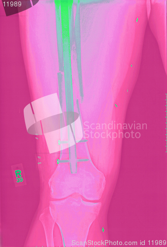 Image of Xray of Femur Fracture Repair after a motorcycle accident. The long rod is held in place by nails.