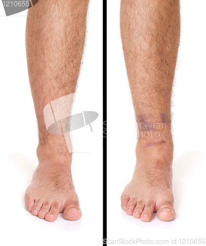 Image of Ankle Sprain