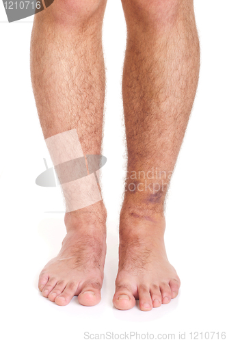 Image of Ankle Sprain