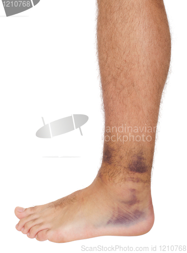 Image of Ankle Sprain