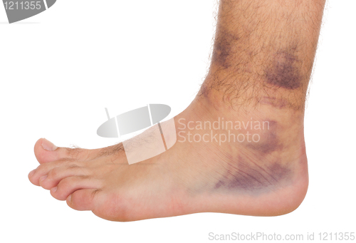 Image of Ankle Sprain