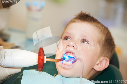 Image of dental filing of child tooth by ultraviolet light