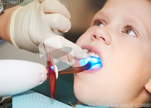 Image of dental filing of child tooth by ultraviolet light