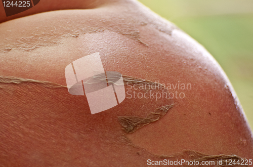 Image of Sunburn, peeling skin.