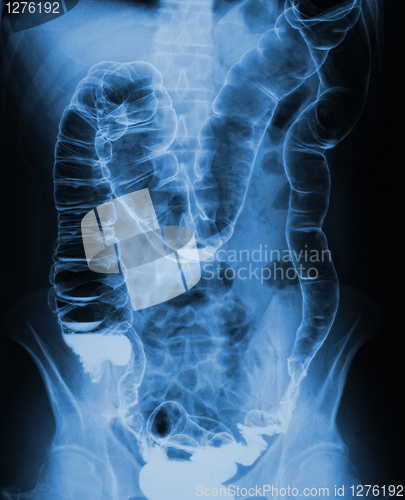 Image of torso xray