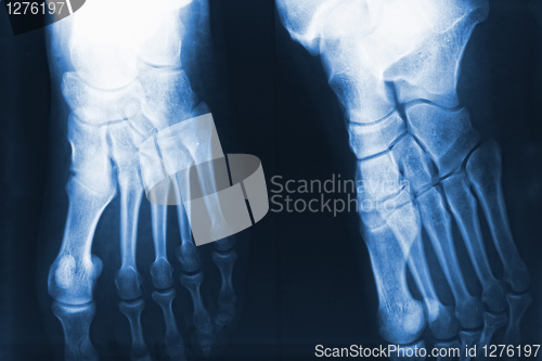 Image of feet xray