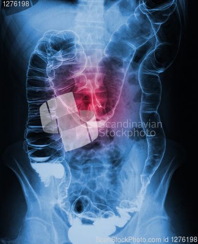 Image of torso xray