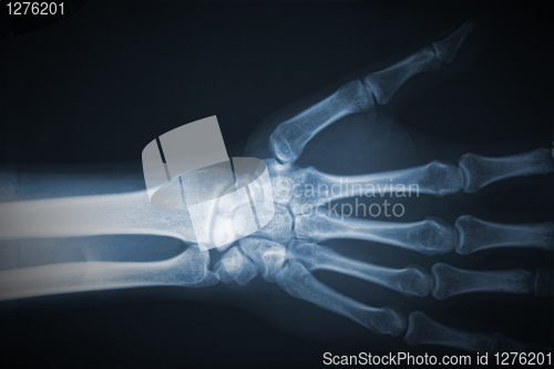 Image of hand xray