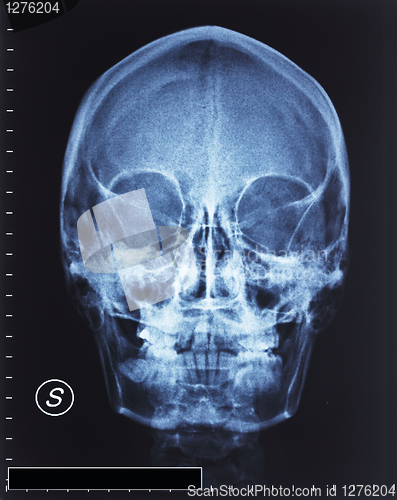 Image of skull xray