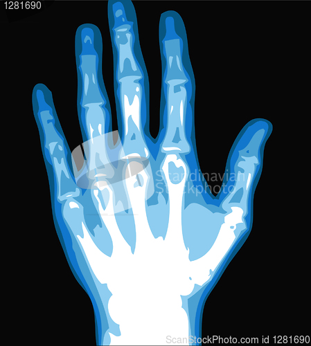 Image of hand xray