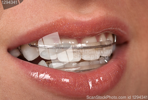 Image of Cosmetic Braces