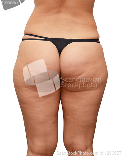 Image of cellulite buttocks