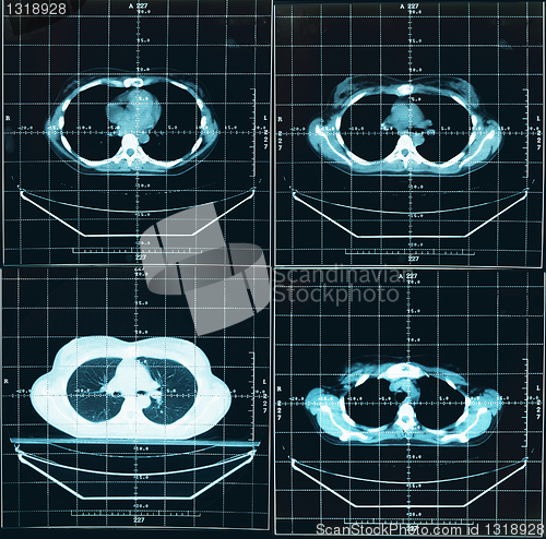 Image of Tomography of human thorax