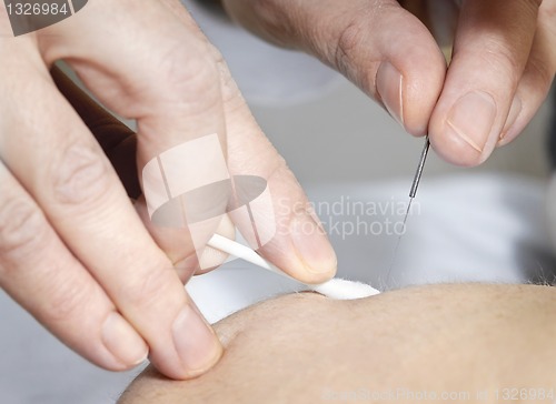 Image of Acupuncture needle in skin