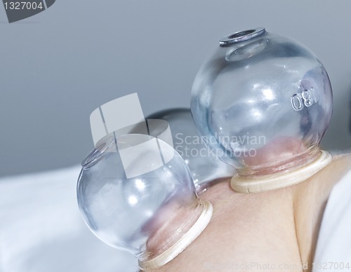 Image of Cupping therapy in traditional chinese medicine
