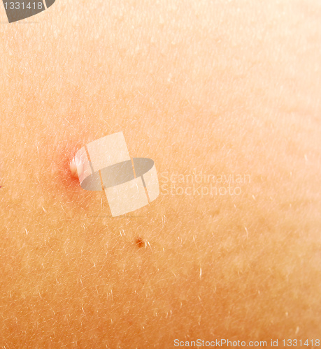 Image of pimple