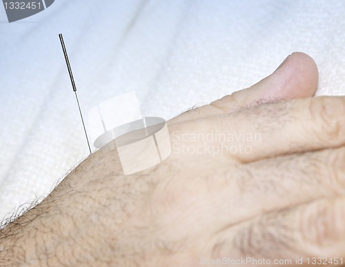 Image of Acupuncture needle in hand