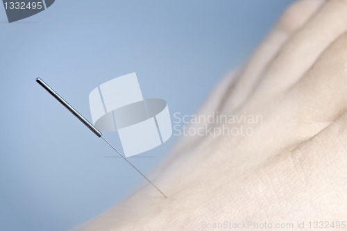 Image of Acupuncture needle in foot