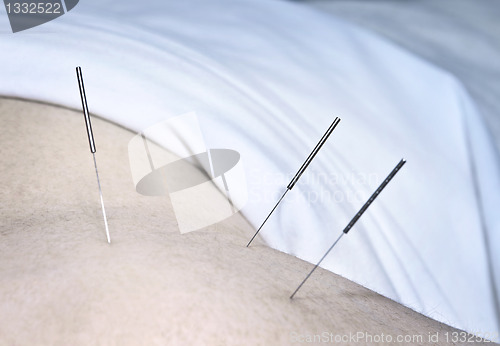 Image of Acupuncture needles in shoulder