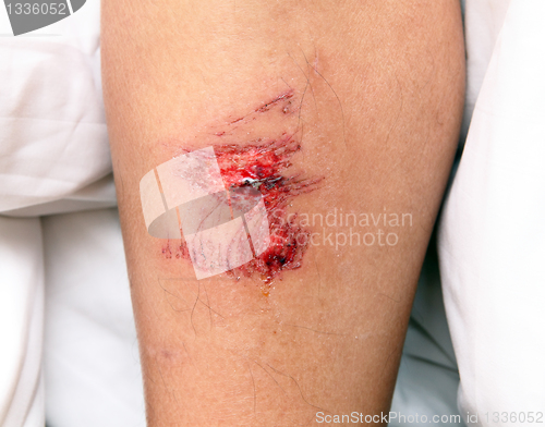 Image of wound