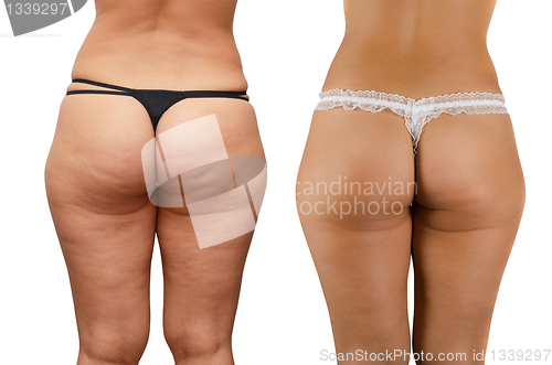 Image of cellulite buttocks