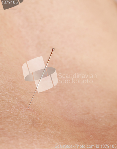Image of Acupuncture needle