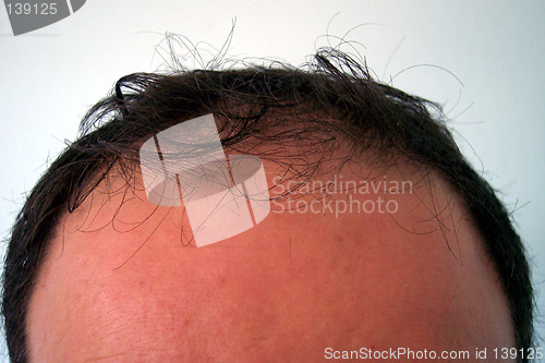 Image of forehead