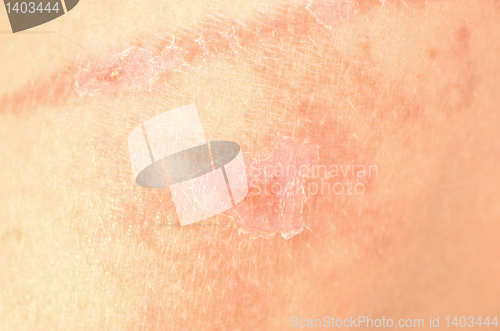 Image of bad skin