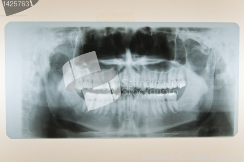 Image of Skull X-Ray