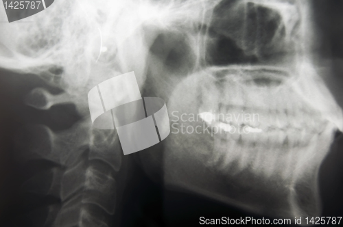 Image of Skull X-Ray