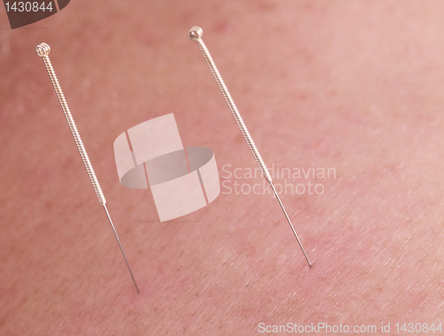 Image of Acupuncture needles